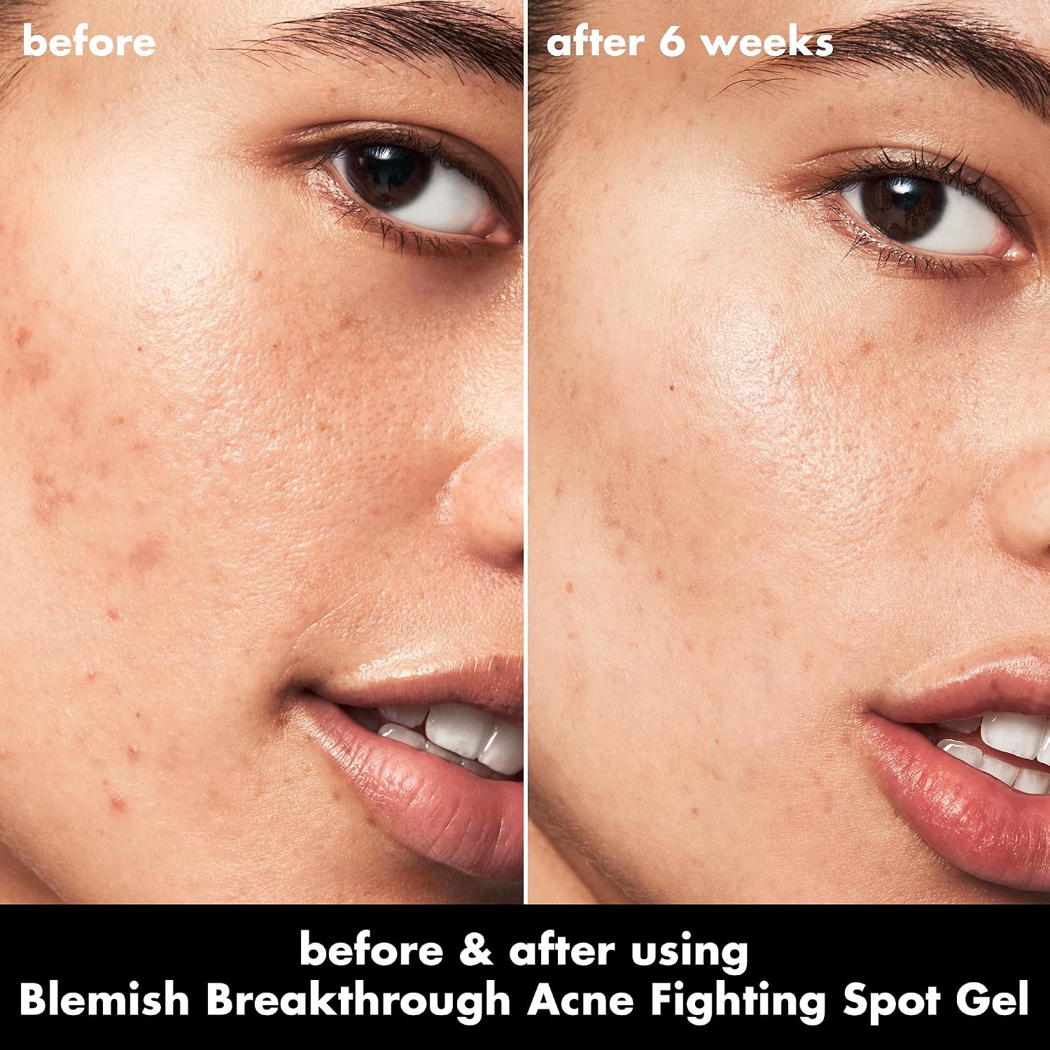 e.l.f. SKIN Blemish Breakthrough Blemish Fighting Spot Gel. Roll-on Blemish Spot Gel For Targeting & Treating Blemishes. Infused With Salicylic Acid